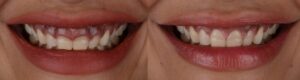 before and after gummy smile